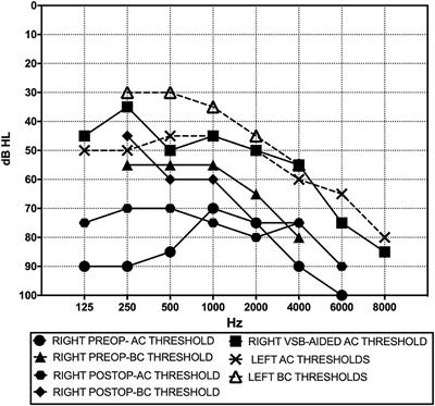 Case Report: Local Anesthesia Round Window Plugging and Simultaneous <mark class="highlighted">Vibrant Soundbridge</mark> Implant for Superior Semicircular Canal Dehiscence